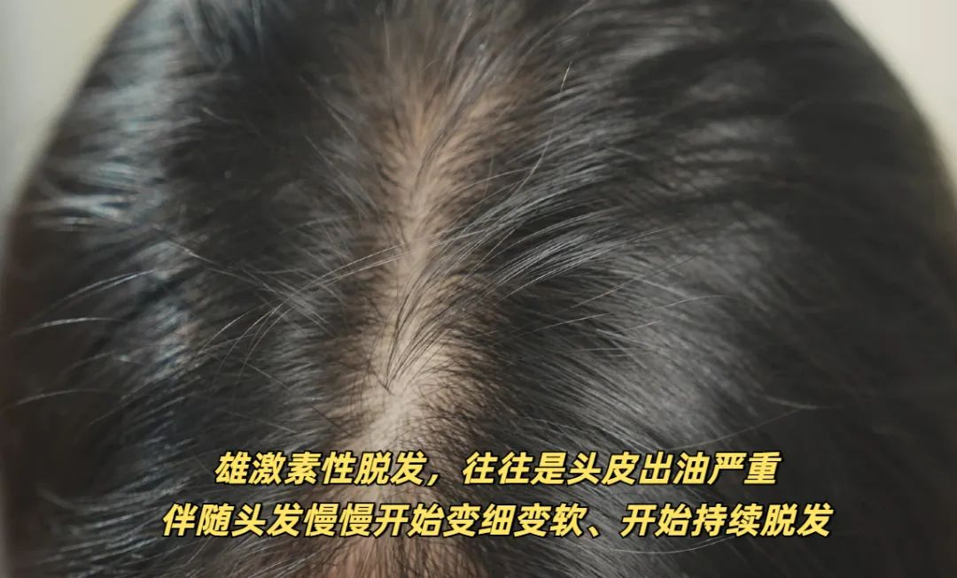 頭油掉發？三步清爽救你！
